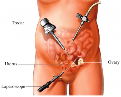 laparoscopical vaginal hysterectomy in Pondicherry