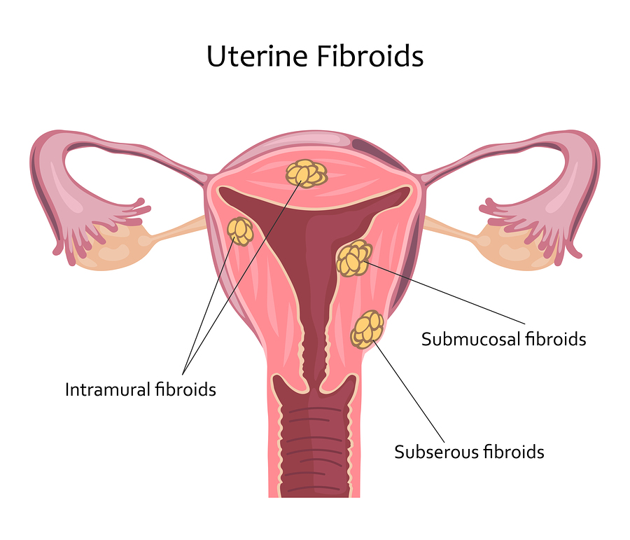 fibroids treatment