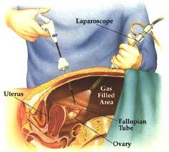 Laparoscopic Tubal Surgery in Pondicherry