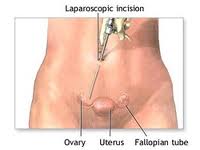 diagnostic laparoscopy in Pondicherry